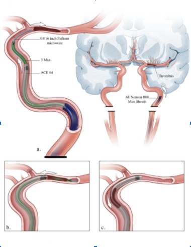 Imagem ilustrativa associada à Trombectomia mecânica no AVC