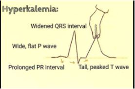 Mudanças no ECG no tratamento da hipercalemia