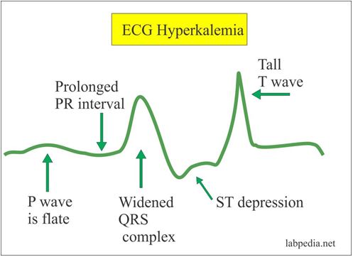 Entenda o porquê do tratamento da hipercalemia