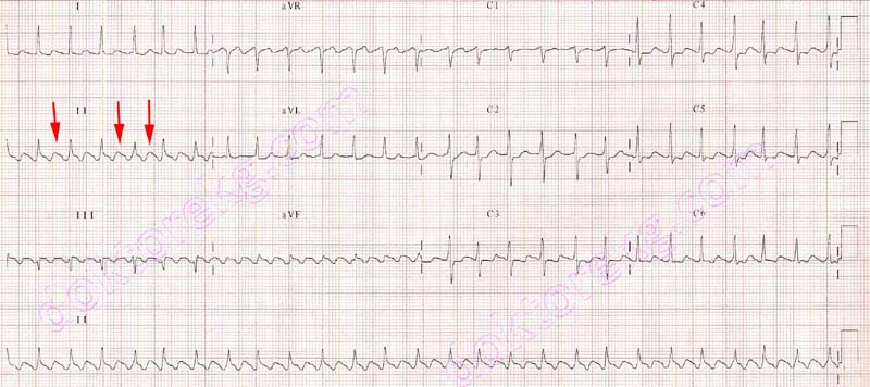 Flutter atrial 2:1, outro tipo de taquiarritmia contemplada pelo protocolo de taquiarritmias do ACLS 