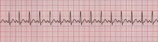Taquicardia sinusal, um dos tipos de taquiarritmia abordados pelo ACLS 
