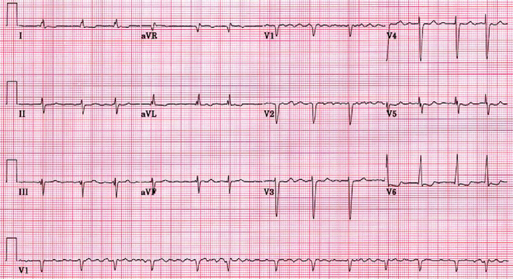 Fibrilação atrial, mais um tipo de taquiarritmia contemplada pelo protocolo de taquiarritmias do ACLS 
