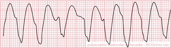 Figura 6 - Taquicardia ventricular (TV), outro cenário comum durante a parada cardiorrespiratória