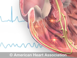 Eletrocardiograma demonstrando traçado em ritmo sinusal na parte superior e fibrilação ventricular (FV) na parte inferior. 