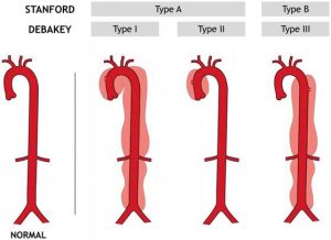 Classificação de dissecção de aorta, uma das urgências e emergências hipertensivas