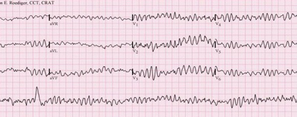 Figura 5 - Fibrilação ventricular (FV). Perceba o ritmo caótico, sem distinção de ondas e intervalos no eletrocardiograma, que define o cenário de parada cardiorrespiratória. 