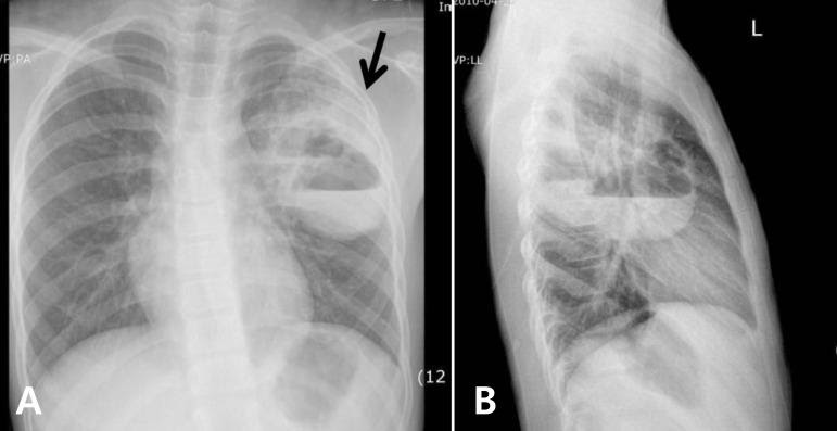 Raio-X de tórax mostrando abscesso pulmonar 