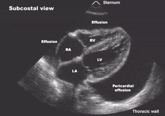 Imagem ecocardiográfica de derrame pericárdico, um outro tipo de pericardite.