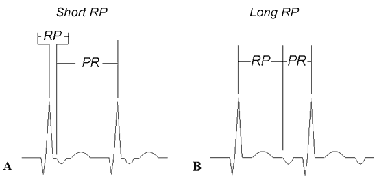 Figura 5 – Figura representativa da TRN típica com intervalo RP curto e menor que o intervalo PR (A); TRN atípica com intervalo RP longo e maior que o intervalo PR (B).