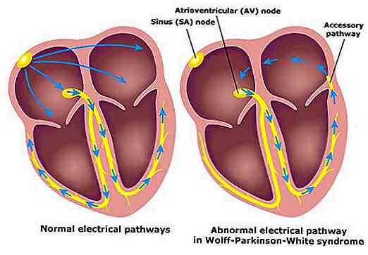 Figura 3 – Demonstração de uma via acessória que pode fazer parte de um circuito de reentrada e persistência de uma taquicardia supraventricular. Nesta situação encontraremos QRS largo