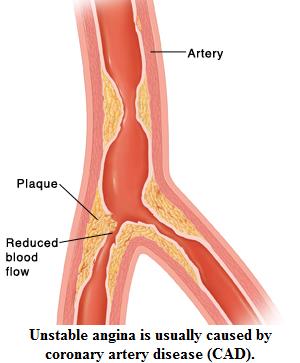 Figura 2 – Lesão de bifurcação em artérias coronárias – causa de desbalanço entre oferta e consumo de oxigênio, que especialmente aos esforços, culmina com angina.