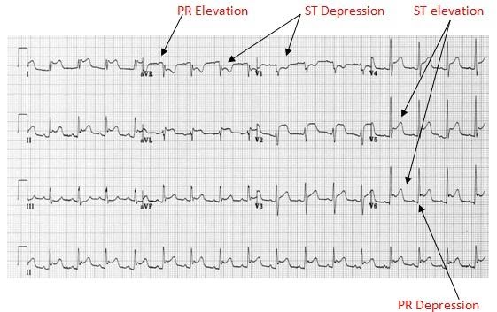 ECG de pericardite aguda.