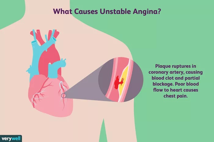Figura 1 – Instabilidade de placa dentro de vaso coronariano: uma causa de angina instável.