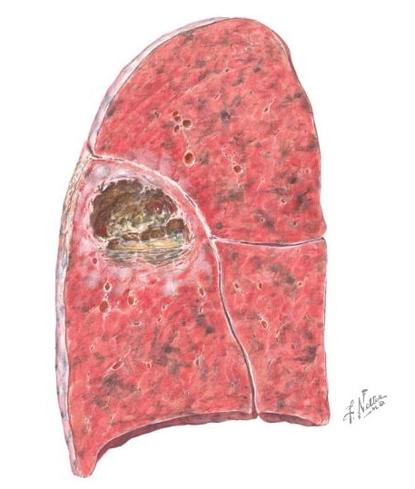 Seção sagital do pulmão com abscesso pulmonar