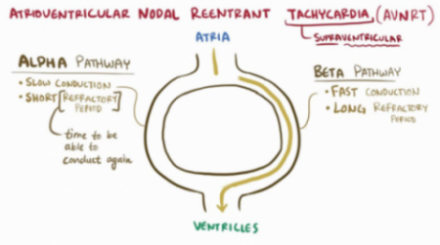 Figura 4 – Vias de condução no nó atrioventricular, que ocorre na taquicardia supraventricular