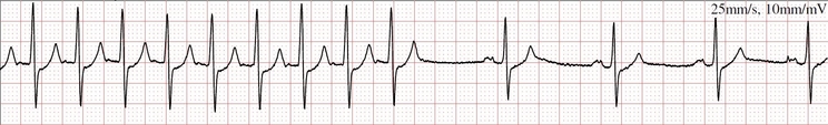 Figura 1 – Fim de uma taquicardia supraventricular e retomada ao ritmo sinusal.