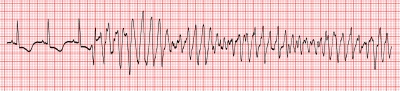 Taquicardia ventricular polimórfica com QT longo