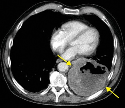 A tomografia computadorizada é outra maneira de identificar um abscesso pulmonar
