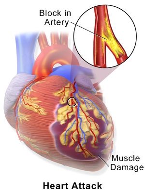 Figura 1 – Imagem ilustrativa de infarto agudo do miocárdio, gerando dano à parede anterior do ventrículo esquerdo.