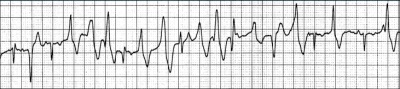 ECG de uma taquicardia ventricular polimórfica