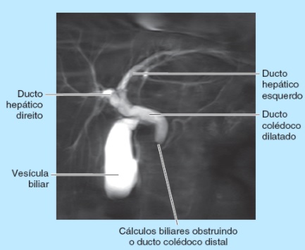 Colangiopancreatografia por RM mostrando dilatação do ducto colécodo secundaria a um cálculo alojado na parte distal do ducto. 