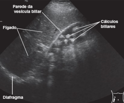 Ultrassonografia da vesícula biliar, importante para compreender a anatomia das vias biliares