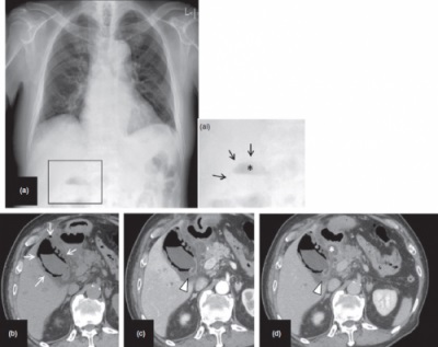 Homem na casa dos 80 anos com colecistite enfisematosa. Radiografia de tórax (a, imagem inserida é uma ampliação da área quadrada), TC simples (b), TC com contraste dinâmico: fase inicial (c), fase de equilíbrio (d). Na radiografia de tórax, gases anormais são aparentes no abdome superior direito. O gás está presente tanto no lúmen da vesícula biliar (ai, *) quanto na parede da vesícula biliar (ai, setas). Na TC simples, o gás é evidente tanto na parede da vesícula biliar quanto no lúmen da vesícula biliar. O aumento de contraste é aparente na parede do colo da vesícula biliar (ponta de seta). A inflamação se espalhou abaixo da mucosa duodenal e um abscesso também está presente. Outro caso em que é possível indicar a cirurgia de colecistite aguda