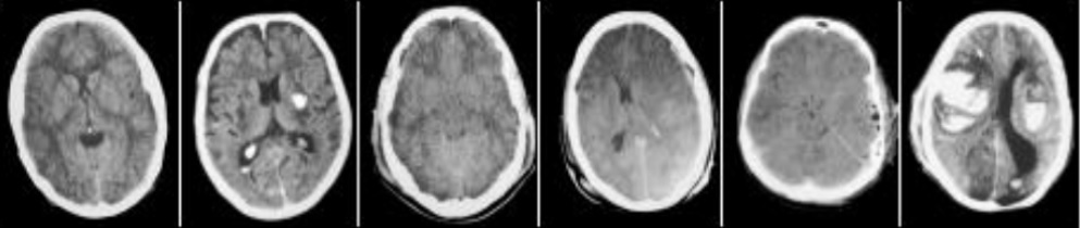Imagem 1 – Imagens tomográficas de cada categoria da Escala de Marshall, da esquerda para a direita, iniciando pela lesão difusa tipo I