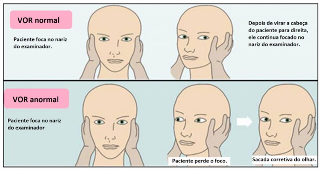 Ilustração do head impulse test