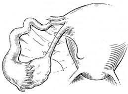 Torção do ovário, comum ao abdome agudo em ginecologia isquêmico