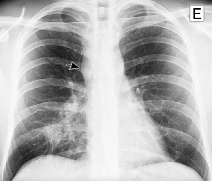 Radiografia de tórax em PA mostra consolidação na região pulmonar inferior direita e linfonodomegalia paratraqueal, indicando uma das doenças relacionadas à pneumonia fúngica