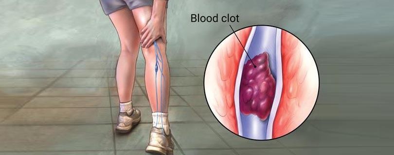 Trombose Venosa Profunda Tudo O Que Voce Precisa Saber Medway