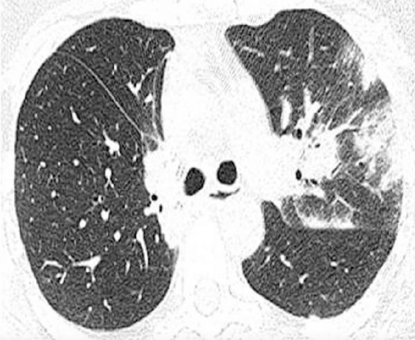 Na maioria dos pacientes com histoplasmose aguda, uma das doenças parecidas com a pneumonia fúngica, a radiografia de tórax é normal. O achado mais comum consiste em consolidação focal ou multifocal maldefinida, frequentemente associada a linfonodomegalia hilar e/ou mediastinal 