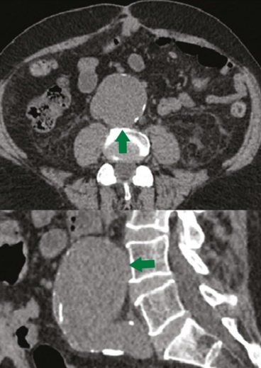 TC evidenciando aneurisma da aorta abdominal, sinal de abdome agudo hemorrágico