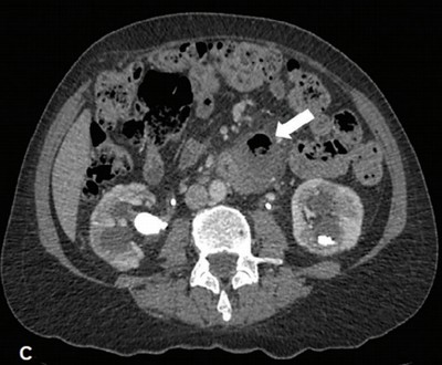 Formação do divertículo de Meckel com sinais de inflamação adjacente.