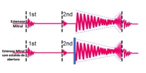 Estenose mitral: tudo que você precisa saber
