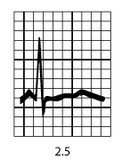 Gráfico de hipocalemia com K = 2,5 mEq/L