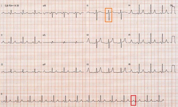 O ECG dos pacientes com estenose mitral não reproduz nenhum padrão específico da doença, mas tão somente alterações secundárias à estenose, como aumento de átrio esquerdo e hipertrofia de ventrículo direito