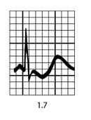 Gráfico de hipocalemia com K = 1,7 mEq/L