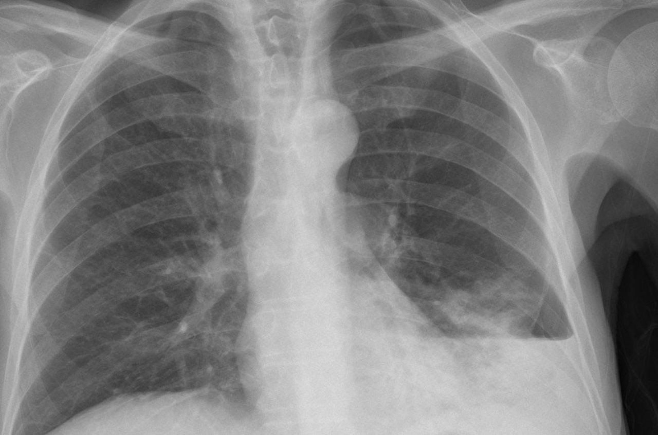 Pneumonia com derrame pleural tudo que você precisa saber Medway