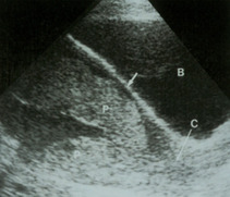 Diagnóstico de placenta prévia através da ultrassonografia transvaginal 