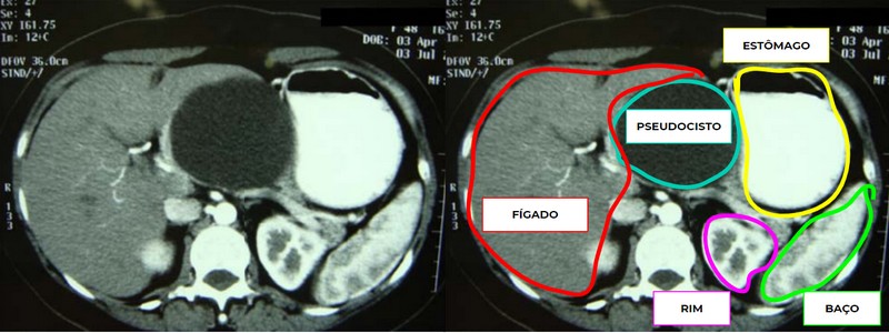 Veja 5 questões de Cirurgia Geral comentadas, que podem te ajudar a aprimorar seus estudos e alcançar melhores resultados.