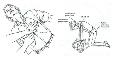 Ilustração mostrando como fazer a compressão torácia para tratar a parada cardiorrespiratória 