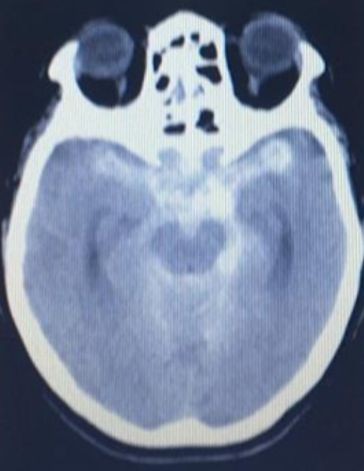 Veja 5 questões de neurologia comentadas e teste seus conhecimentos. O estudo por questões é a melhor forma de reter o aprendizado.