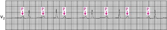 Figura 2 – Eletrocardiograma com o fenômeno de Wenckebach – BAV de 2º grau Mobitz 1 