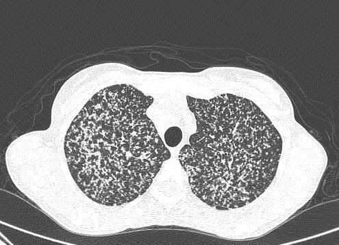 Tomografia de tórax de tuberculose miliar.