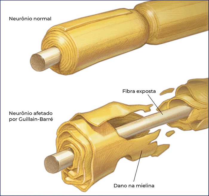 Imagem mostrando como a síndrome de Guillain-Barré afeta o corpo