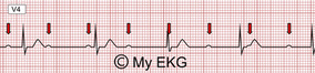 Figura 4 – BAV total ou de 3º grau ou completo. As ondas p são salpicadas no meio do traçado eletrocardiográfico