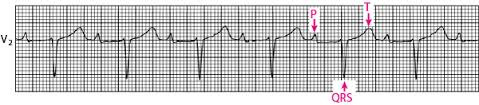 Bloqueio atrioventricular: como identificar e tratar - Medway