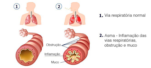 Imagem ilustrativa da asma, que é uma doença inflamatória crônica de vias aéreas, e que gera obstrução reversível ao fluxo aéreo, levando à crise asmática.